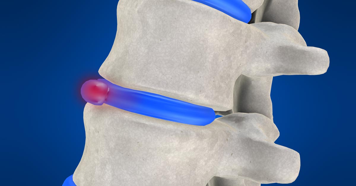 Anchorage non-surgical disc herniation treatment